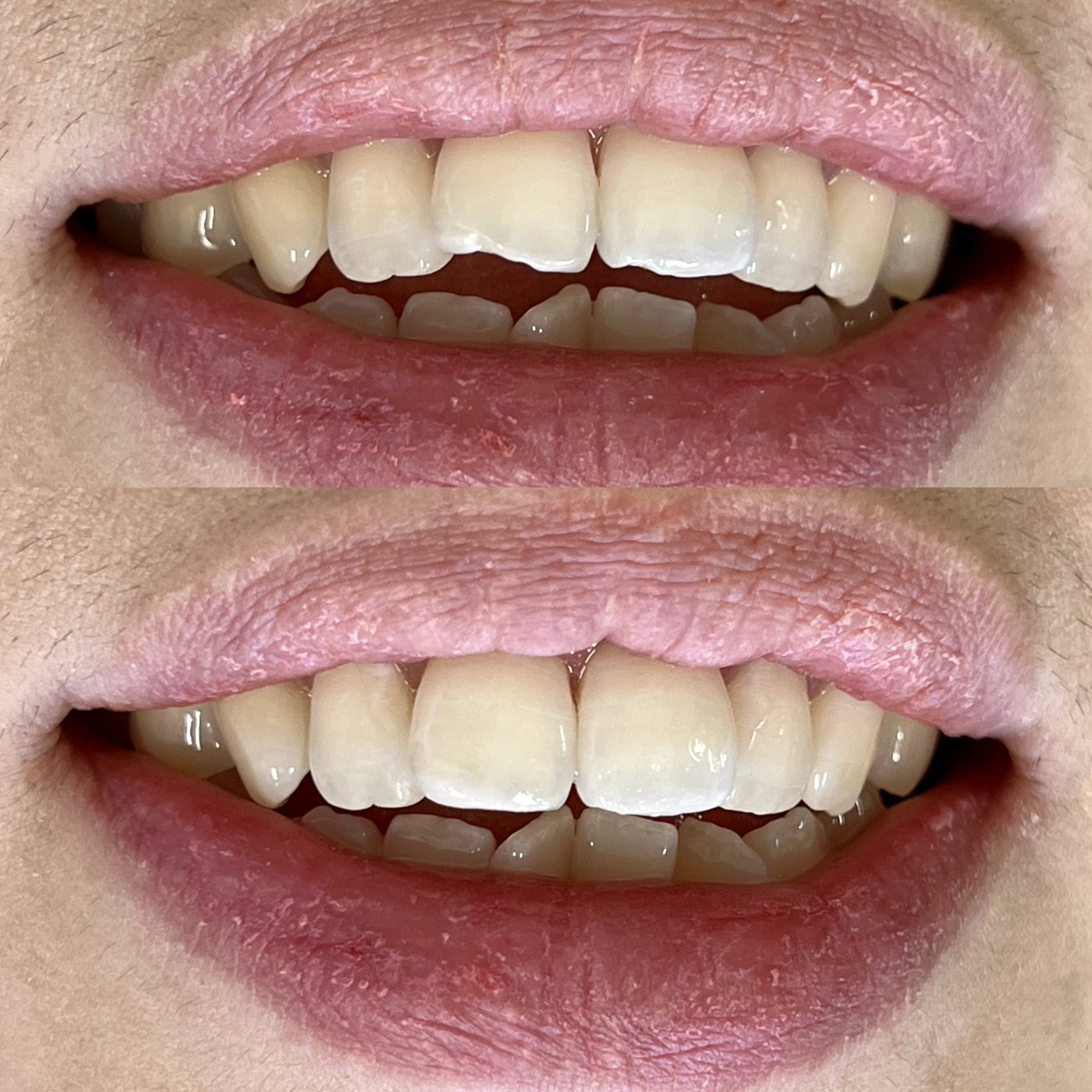 A chipped front tooth before and after chairside restoration
