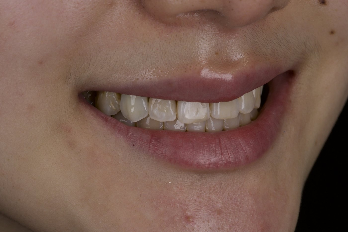 After: an aesthetic crown matched to the surrounding teeth
