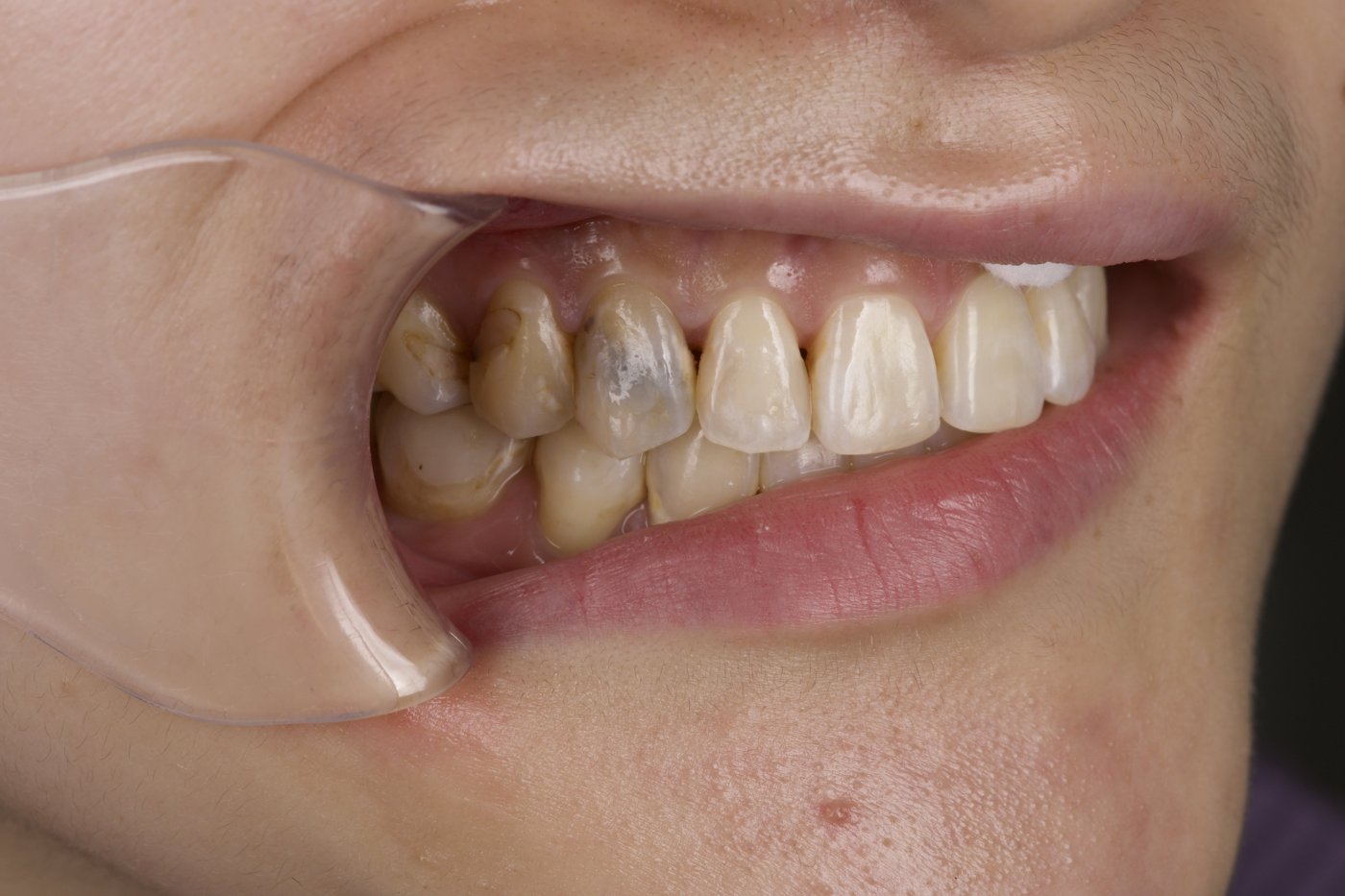 Before: a discolored front tooth