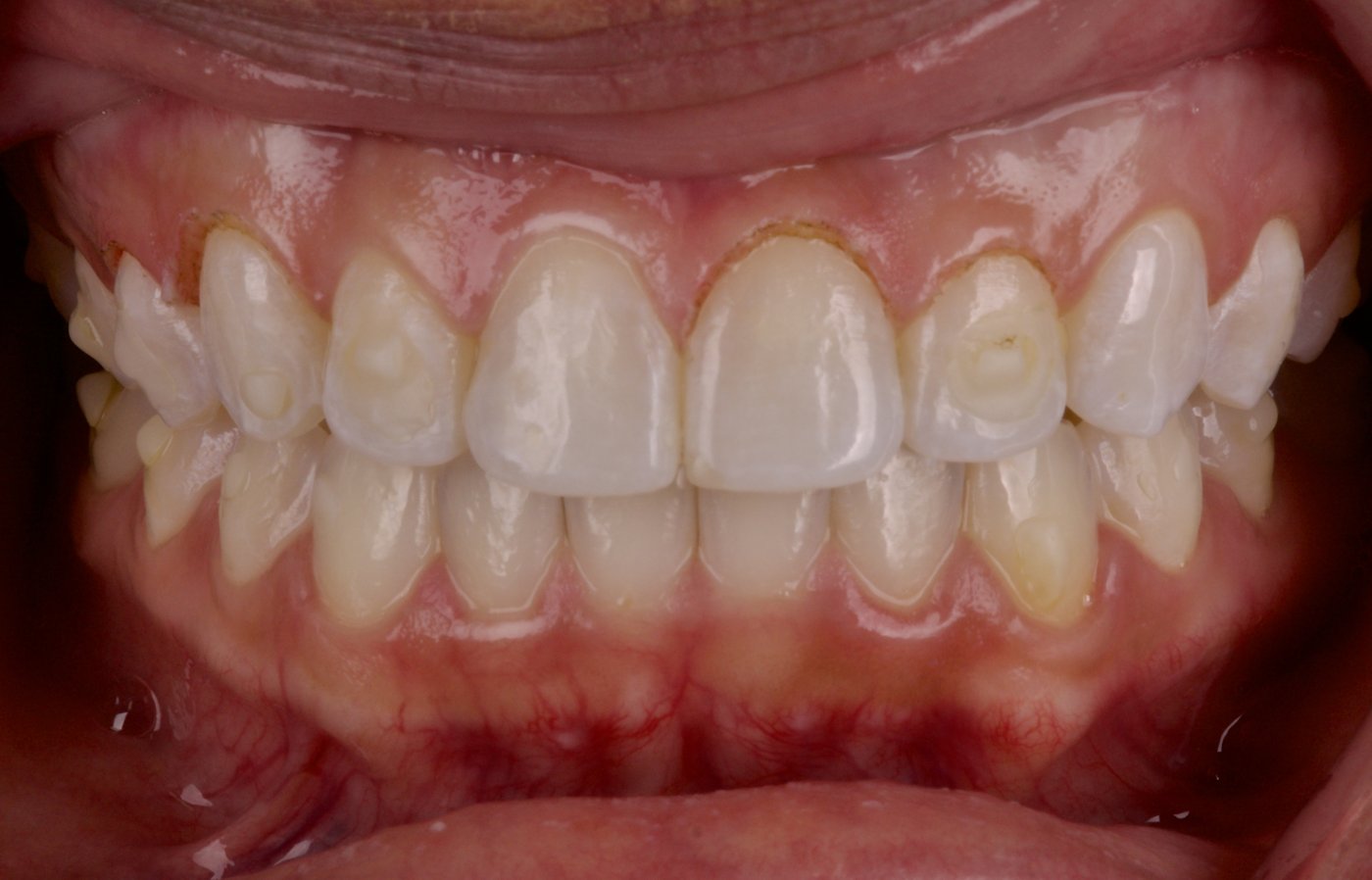 After: gum tissue reshaped with a laser