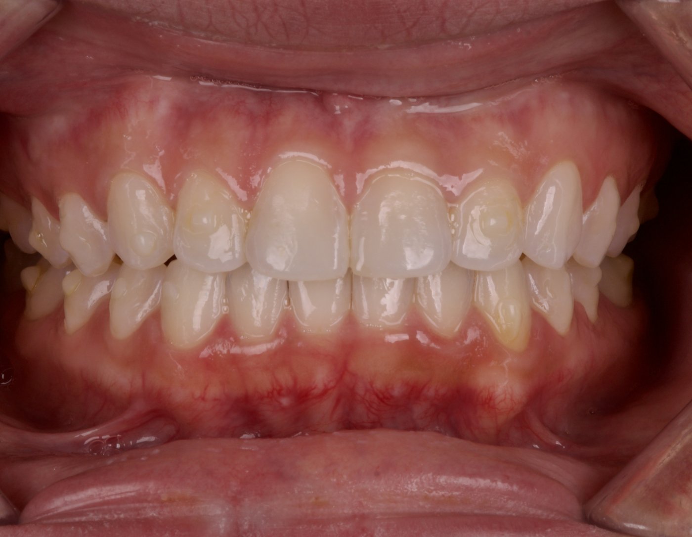 Before: uneven gum tissue