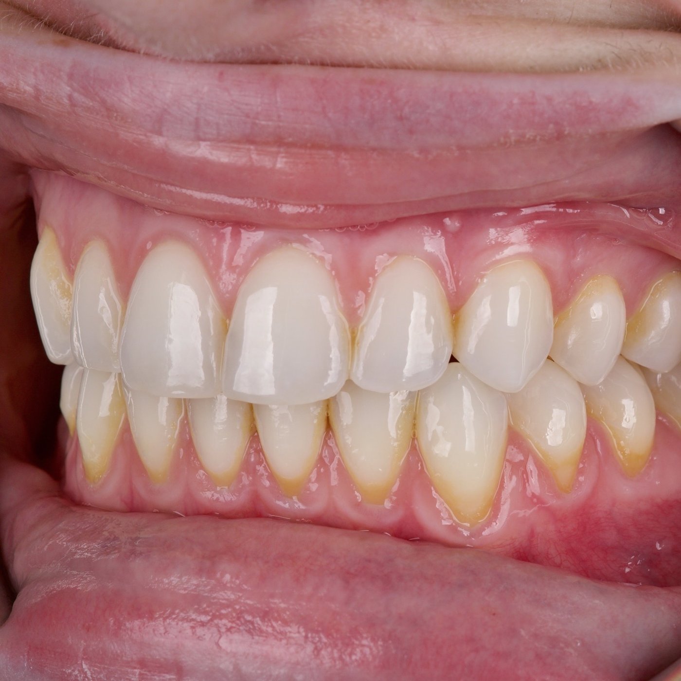 After: a gum graft covering the root