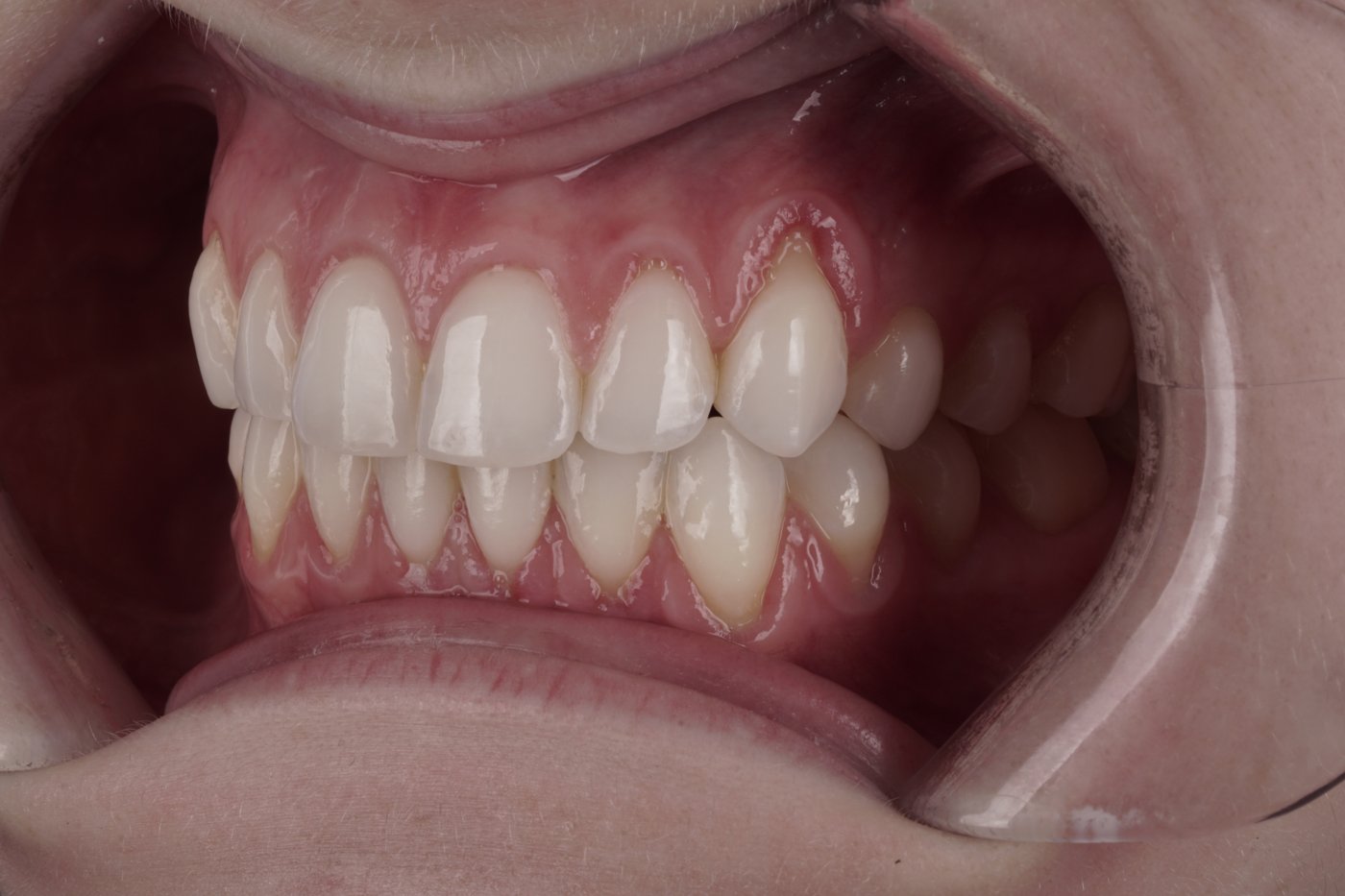 Before: gum recession exposing the tooth root
