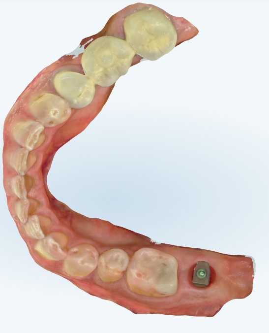 A digital scan of the teeth, used in place of a conventional impression