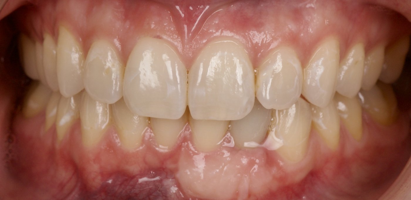 After: an implant restoration matched to the neighboring teeth