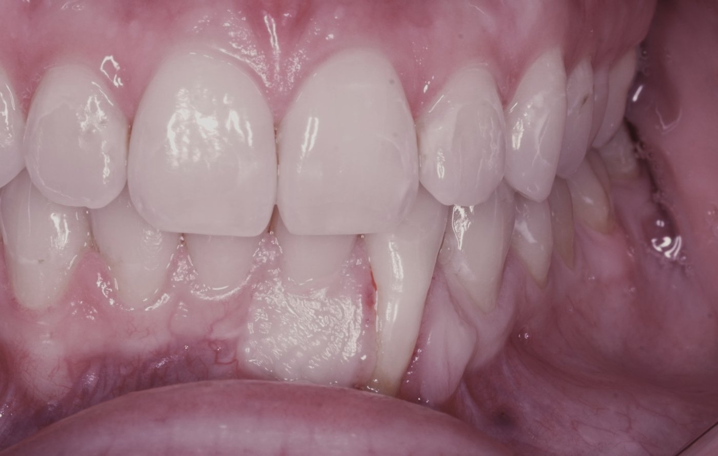 Before: a missing lower front tooth