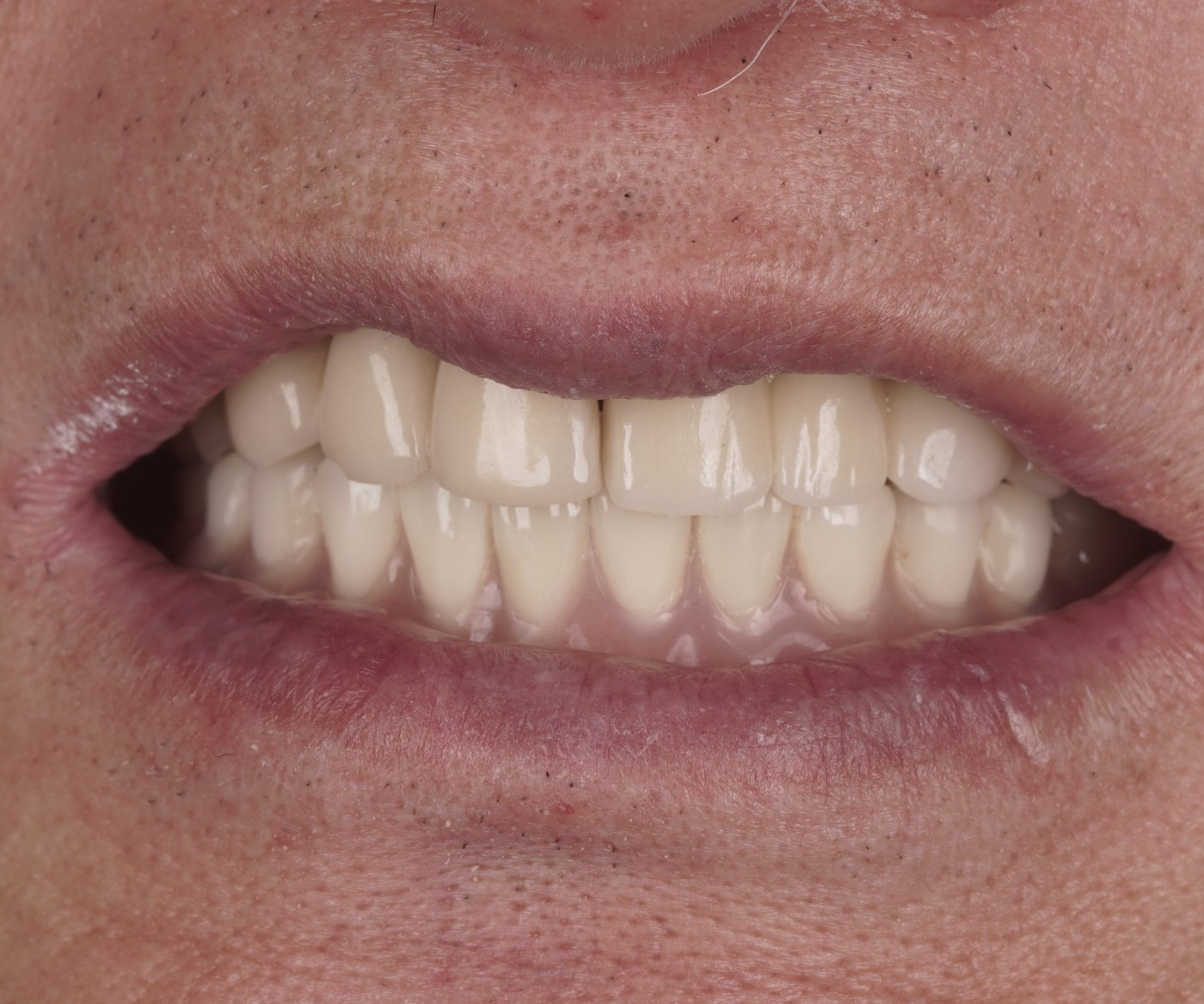 The finished denture fitted onto the implants