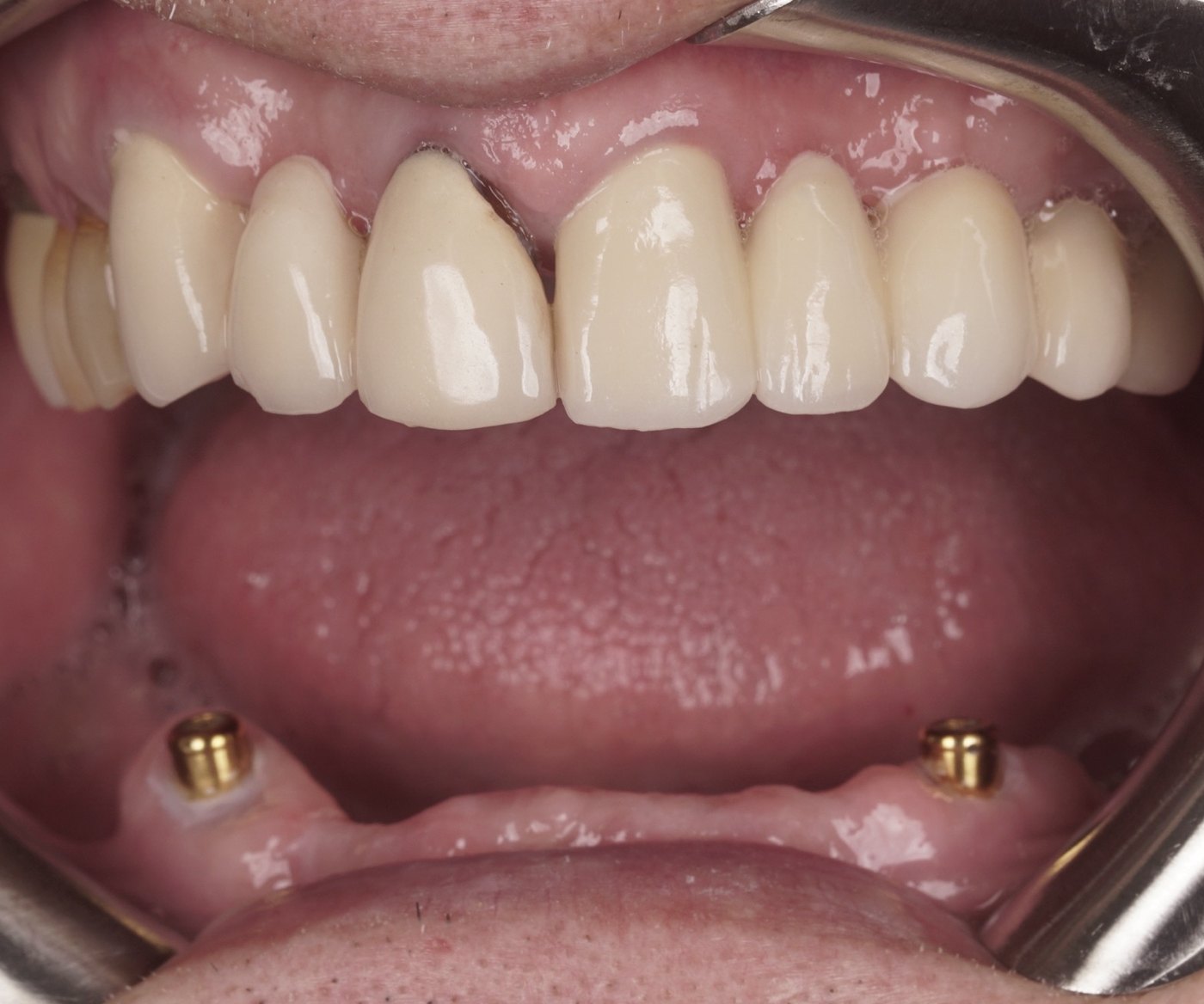 Two dental implants placed in the lower jaw