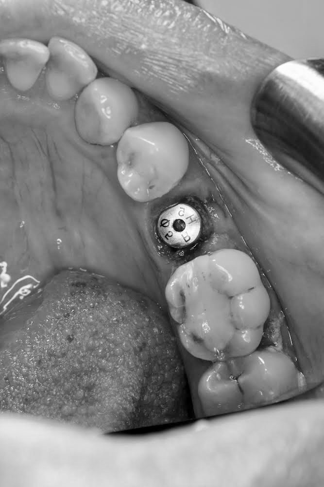 A dental implant positioned precisely within the jaw