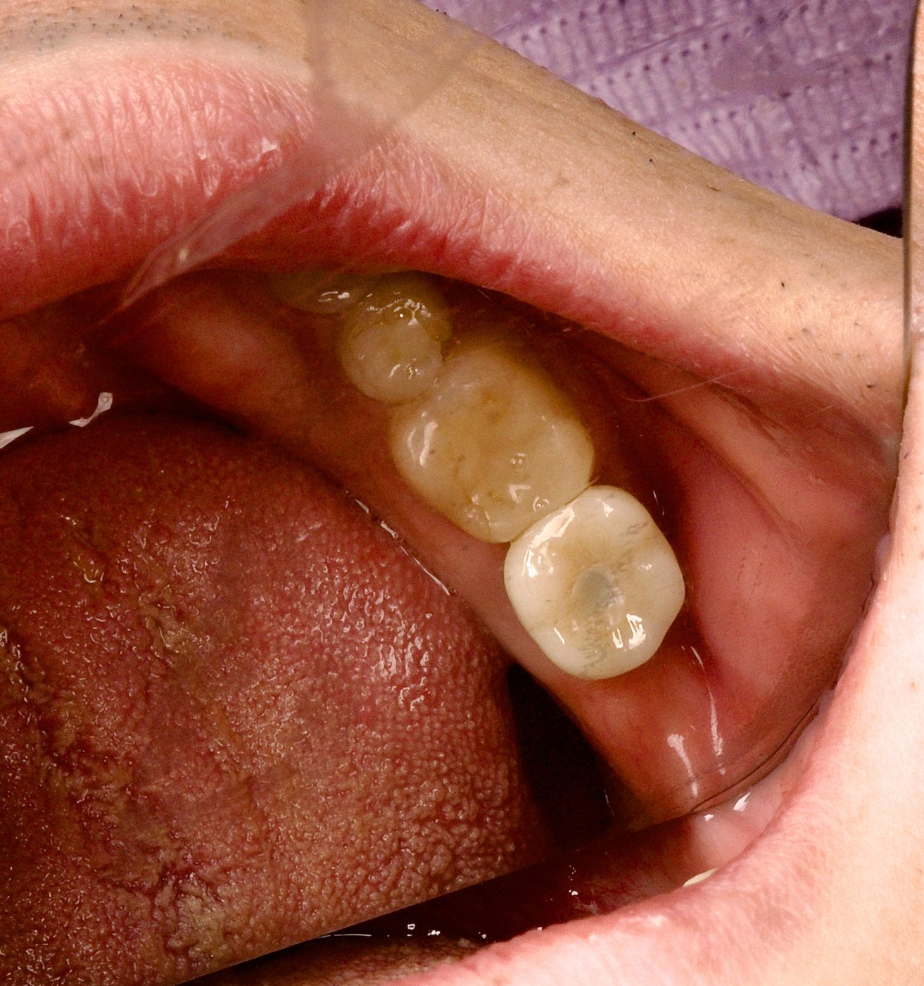 After: a dental implant with a custom crown