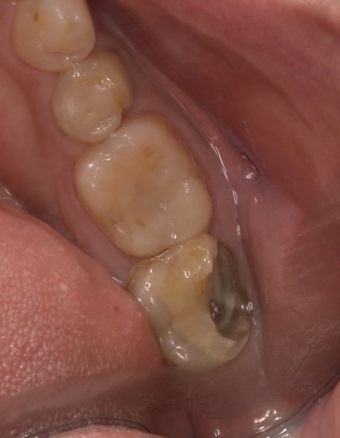 Before: a broken-down back molar