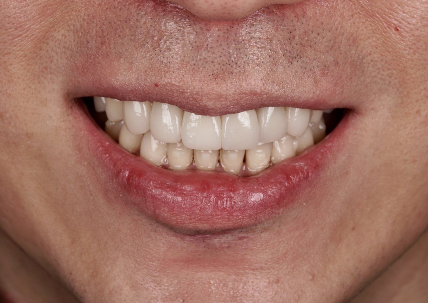 After: porcelain veneers