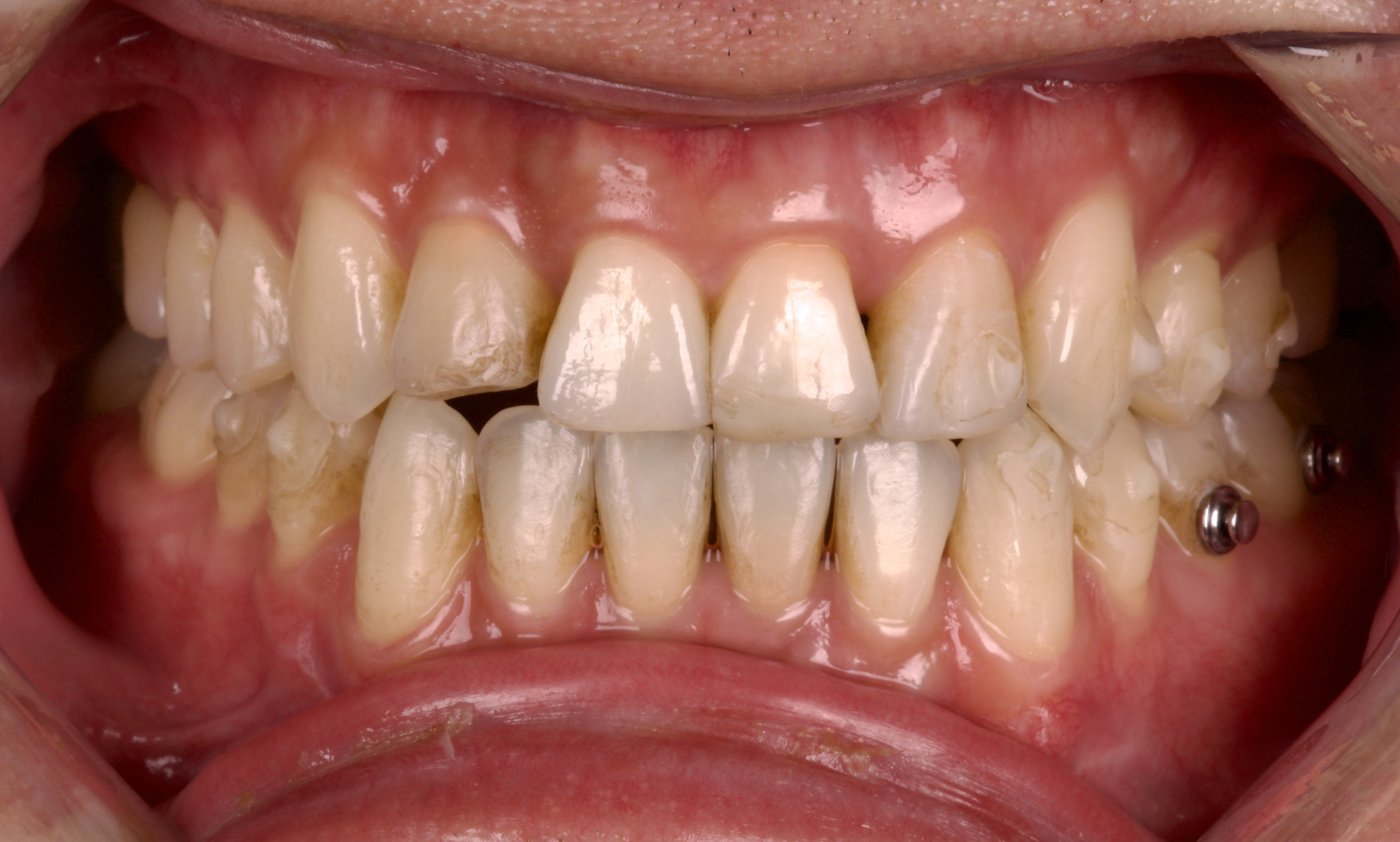 Before: worn, uneven front teeth