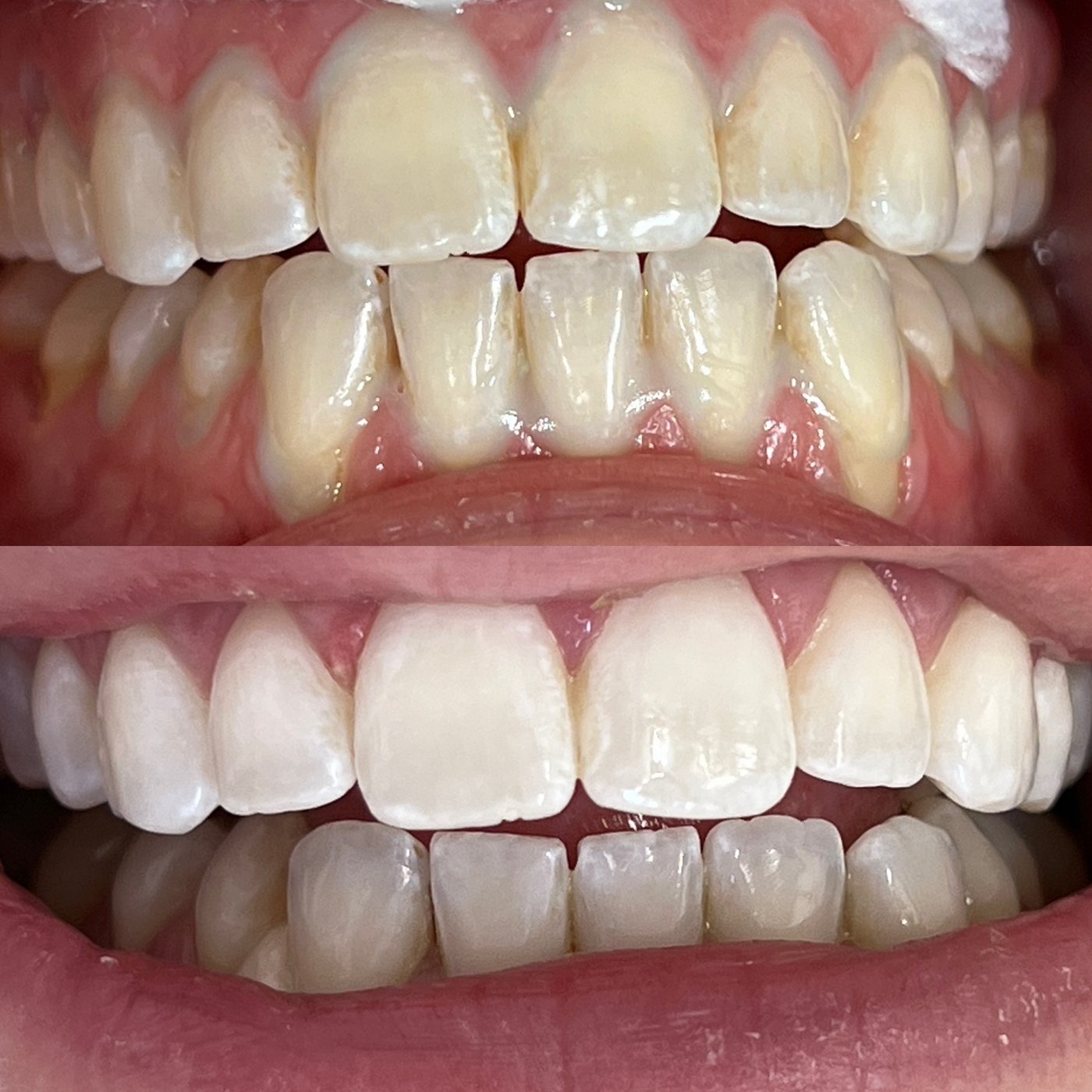 Teeth before and after professional whitening
